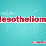 Mesothelioma